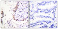 SLC22A3 / OCT3 Antibody - Peptide - + Immunohistochemical analysis of paraffin-embedded human lung carcinoma tissue using OCT3 antibody.
