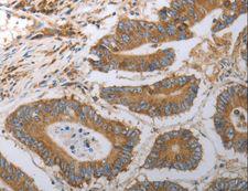 SLC22A6 / OAT1 Antibody - Immunohistochemistry of paraffin-embedded Human colon cancer using SLC22A6 Polyclonal Antibody at dilution of 1:40.