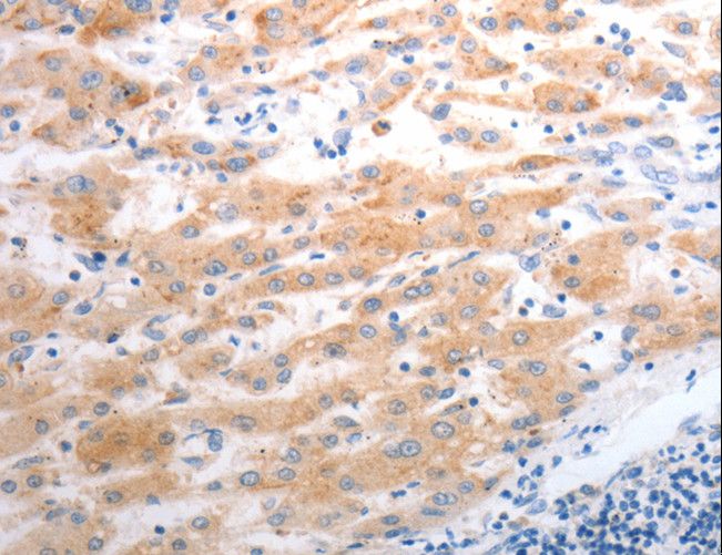 SLC22A6 / OAT1 Antibody - Immunohistochemistry of paraffin-embedded Human liver cancer using SLC22A6 Polyclonal Antibody at dilution of 1:40.