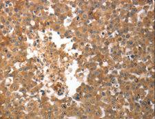 SLC22A6 / OAT1 Antibody - Immunohistochemistry of paraffin-embedded Human breast cancer using SLC22A6 Polyclonal Antibody at dilution of 1:50.