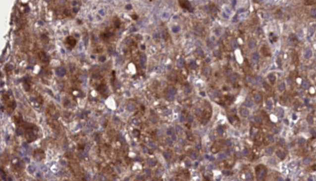SLC22A6 / OAT1 Antibody - 1:100 staining human liver carcinoma tissues by IHC-P. The sample was formaldehyde fixed and a heat mediated antigen retrieval step in citrate buffer was performed. The sample was then blocked and incubated with the antibody for 1.5 hours at 22°C. An HRP conjugated goat anti-rabbit antibody was used as the secondary.