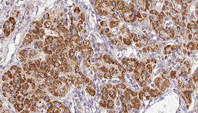 SLC22A6 / OAT1 Antibody - 1:100 staining human liver carcinoma tissues by IHC-P. The sample was formaldehyde fixed and a heat mediated antigen retrieval step in citrate buffer was performed. The sample was then blocked and incubated with the antibody for 1.5 hours at 22°C. An HRP conjugated goat anti-rabbit antibody was used as the secondary.