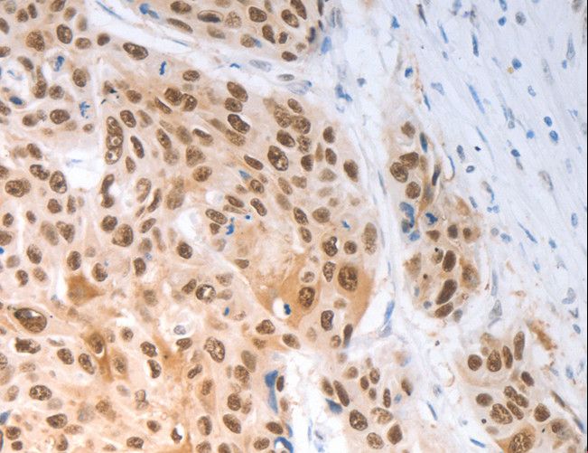 SLC22A8 / OAT3 Antibody - Immunohistochemistry of paraffin-embedded Human esophagus cancer using SLC22A8 Polyclonal Antibody at dilution of 1:70.