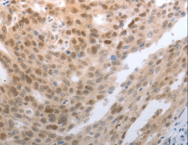 SLC22A8 / OAT3 Antibody - Immunohistochemistry of paraffin-embedded Human esophagus cancer using SLC22A8 Polyclonal Antibody at dilution of 1:70.