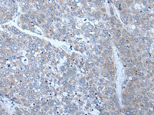 SLC24A5 / NCKX5 Antibody - Immunohistochemistry of paraffin-embedded Human liver cancer tissue  using SLC24A5 Polyclonal Antibody at dilution of 1:50(×200)