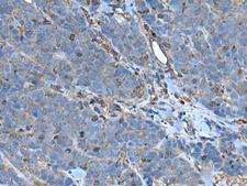 SLC24A5 / NCKX5 Antibody - Immunohistochemistry of paraffin-embedded Human thyroid cancer tissue  using SLC24A5 Polyclonal Antibody at dilution of 1:50(×200)