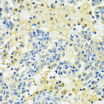 SLC25A1 / SEA Antibody - Immunohistochemistry of paraffin-embedded human lung cancer using SLC25A1 antibodyat dilution of 1:100 (40x lens).