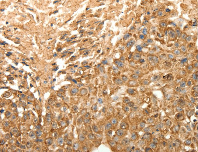SLC25A11 Antibody - Immunohistochemistry of paraffin-embedded Human esophagus cancer using SLC25A11 Polyclonal Antibody at dilution of 1:30.