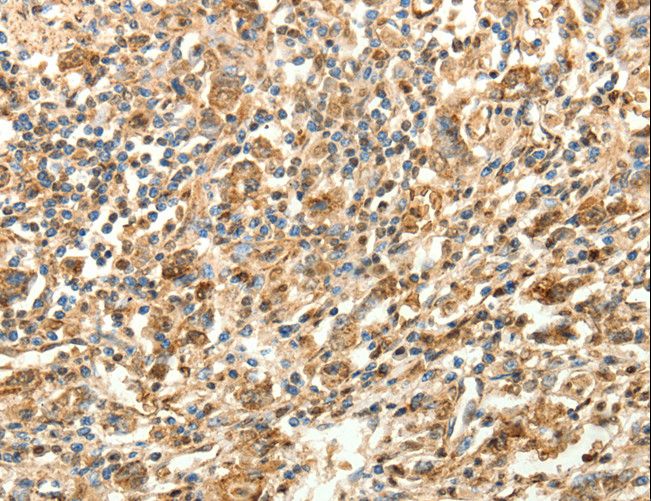 SLC25A11 Antibody - Immunohistochemistry of paraffin-embedded Human gastric cancer using SLC25A11 Polyclonal Antibody at dilution of 1:30.