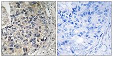 SLC25A12 / ARALAR Antibody - Immunohistochemistry analysis of paraffin-embedded human prostate carcinoma tissue, using CMC1 Antibody. The picture on the right is blocked with the synthesized peptide.