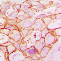 SLC25A12 / ARALAR Antibody - Immunohistochemical analysis of ARALAR1 staining in human breast cancer formalin fixed paraffin embedded tissue section. The section was pre-treated using heat mediated antigen retrieval with sodium citrate buffer (pH 6.0). The section was then incubated with the antibody at room temperature and detected using an HRP conjugated compact polymer system. DAB was used as the chromogen. The section was then counterstained with hematoxylin and mounted with DPX.