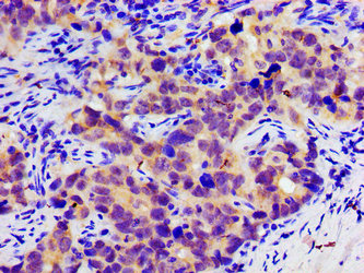 SLC25A12 / ARALAR Antibody - Immunohistochemistry image of paraffin-embedded human pancreatic cancer at a dilution of 1:100