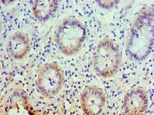 SLC25A13 / CITRIN Antibody - Immunohistochemistry of paraffin-embedded human rectal cancer using antibody at 1:100 dilution.