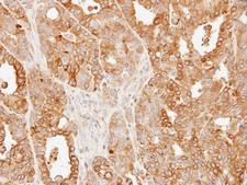 SLC25A13 / CITRIN Antibody - IHC of paraffin-embedded N87 xenograft using SLC25A13 antibody at 1:500 dilution.