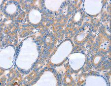 SLC25A13 / CITRIN Antibody - Immunohistochemistry of paraffin-embedded Human thyroid cancer using SLC25A13 Polyclonal Antibody at dilution of 1:35.