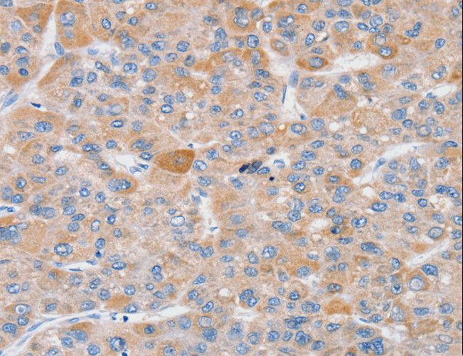 SLC25A13 / CITRIN Antibody - Immunohistochemistry of paraffin-embedded Human liver cancer using SLC25A13 Polyclonal Antibody at dilution of 1:35.