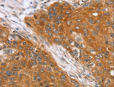 SLC25A13 / CITRIN Antibody - Immunohistochemistry of paraffin-embedded Human esophagus cancer using SLC25A13 Polyclonal Antibody at dilution of 1:35.