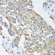 SLC25A13 / CITRIN Antibody - Immunohistochemistry of paraffin-embedded human lung cancer using SLC25A13 antibody at dilution of 1:100 (40x lens).