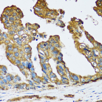 SLC25A13 / CITRIN Antibody - Immunohistochemistry of paraffin-embedded human colon carcinoma using SLC25A13 antibody at dilution of 1:100 (40x lens).