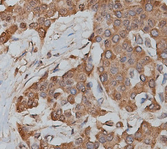SLC25A13 / CITRIN Antibody - 1:200 staining human lymphoma tissue by IHC-P. The tissue was formaldehyde fixed and a heat mediated antigen retrieval step in citrate buffer was performed. The tissue was then blocked and incubated with the antibody for 1.5 hours at 22°C. An HRP conjugated goat anti-rabbit antibody was used as the secondary.