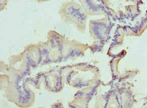 SLC25A20 / CACT Antibody - Immunohistochemistry of paraffin-embedded human prostate cancer at dilution 1:100