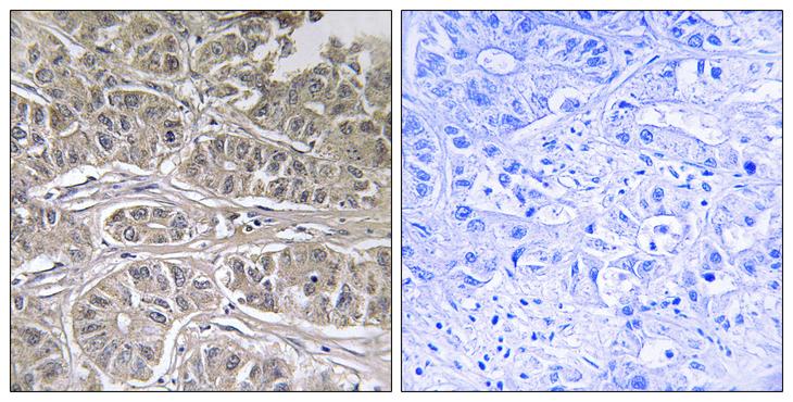 SLC25A21 / ODC1 Antibody - Peptide - + Immunohistochemistry analysis of paraffin-embedded human liver carcinoma tissue using SLC25A21 antibody.