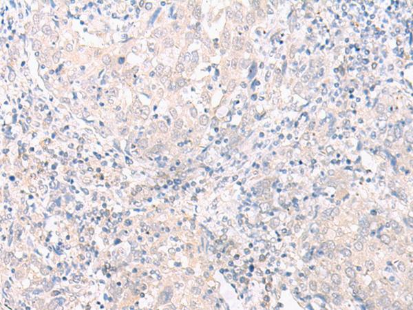 SLC25A27 / UCP4 Antibody - Immunohistochemistry of paraffin-embedded Human cervical cancer tissue  using SLC25A27 Polyclonal Antibody at dilution of 1:30(×200)