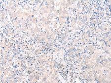 SLC25A27 / UCP4 Antibody - Immunohistochemistry of paraffin-embedded Human cervical cancer tissue  using SLC25A27 Polyclonal Antibody at dilution of 1:30(×200)