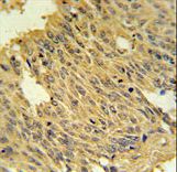SLC25A28 Antibody - MFRN2 Antibody IHC of formalin-fixed and paraffin-embedded human lung carcinoma followed by peroxidase-conjugated secondary antibody and DAB staining.