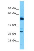 SLC25A30 Antibody - SLC25A30 antibody Western Blot of Uterus Tumor. Antibody dilution: 1 ug/ml.  This image was taken for the unconjugated form of this product. Other forms have not been tested.