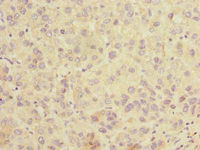 SLC25A36 Antibody - Immunohistochemistry of paraffin-embedded human liver cancer using antibody at dilution of 1:100.