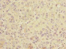 SLC25A36 Antibody - Immunohistochemistry of paraffin-embedded human liver cancer using antibody at dilution of 1:100.