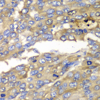 SLC25A4 / ANT Antibody - Immunohistochemistry of paraffin-embedded human liver cancer tissue.