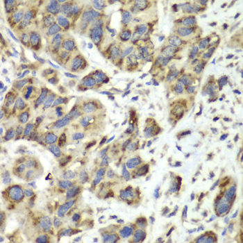 SLC25A4 / ANT Antibody - Immunohistochemistry of paraffin-embedded human esophageal cancer tissue.