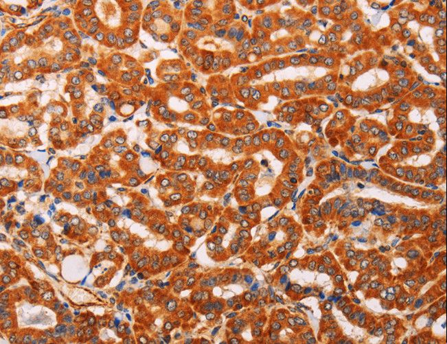 SLC25A4 / ANT Antibody - Immunohistochemistry of paraffin-embedded Human thyroid cancer using SLC25A4 Polyclonal Antibody at dilution of 1:40.