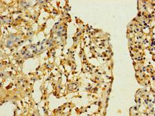 SLC25A40 Antibody - Immunohistochemistry of paraffin-embedded human bladder cancer using SLC25A40 Antibody at dilution of 1:100