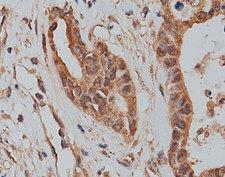 SLC25A46 Antibody - 1:200 staining human colon carcinoma tissue by IHC-P. The tissue was formaldehyde fixed and a heat mediated antigen retrieval step in citrate buffer was performed. The tissue was then blocked and incubated with the antibody for 1.5 hours at 22°C. An HRP conjugated goat anti-rabbit antibody was used as the secondary.