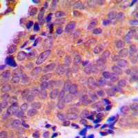 SLC25A6 / ANT3 Antibody - Immunohistochemical analysis of ANT3 staining in human breast cancer formalin fixed paraffin embedded tissue section. The section was pre-treated using heat mediated antigen retrieval with sodium citrate buffer (pH 6.0). The section was then incubated with the antibody at room temperature and detected using an HRP conjugated compact polymer system. DAB was used as the chromogen. The section was then counterstained with hematoxylin and mounted with DPX.