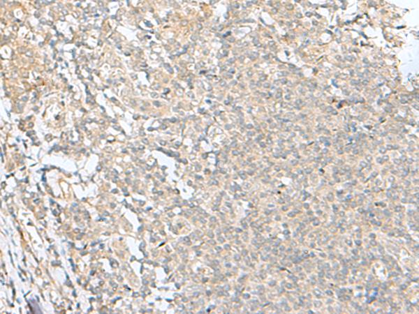 SLC26A3 / DRA Antibody - Immunohistochemistry of paraffin-embedded Human tonsil tissue  using SLC26A3 Polyclonal Antibody at dilution of 1:35(×200)
