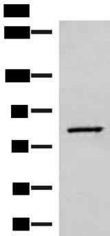 SLC26A3 / DRA Antibody - Western blot analysis of Human hepatocellular carcinoma tissue lysate  using SLC26A3 Polyclonal Antibody at dilution of 1:250