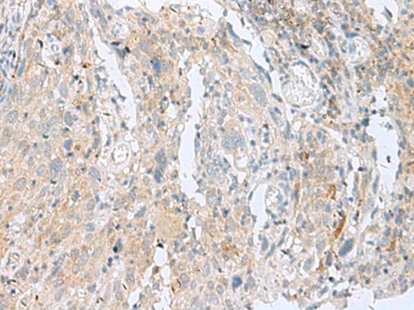 SLC26A3 / DRA Antibody - Immunohistochemistry of paraffin-embedded Human cervical cancer tissue  using SLC26A3 Polyclonal Antibody at dilution of 1:35(×200)