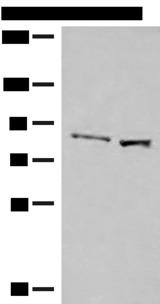 SLC26A3 / DRA Antibody - Western blot analysis of Human hepatocellular carcinoma tissue and HepG2 cell lysates  using SLC26A3 Polyclonal Antibody at dilution of 1:250