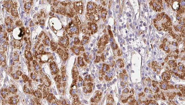 SLC26A5 Antibody - 1:100 staining human liver carcinoma tissues by IHC-P. The sample was formaldehyde fixed and a heat mediated antigen retrieval step in citrate buffer was performed. The sample was then blocked and incubated with the antibody for 1.5 hours at 22°C. An HRP conjugated goat anti-rabbit antibody was used as the secondary.