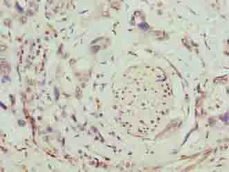 SLC26A8 / TAT1 Antibody - Immunohistochemistry of paraffin-embedded human pancreatic cancer using antibody at dilution of 1:100.