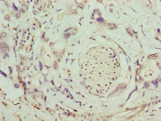 SLC26A8 / TAT1 Antibody - Immunohistochemistry of paraffin-embedded human pancreatic cancer using SLC26A8 Antibody at dilution of 1:100