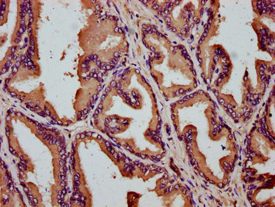 SLC26A9 Antibody - Immunohistochemistry Dilution at 1:200 and staining in paraffin-embedded human prostate tissue performed on a Leica BondTM system. After dewaxing and hydration, antigen retrieval was mediated by high pressure in a citrate buffer (pH 6.0). Section was blocked with 10% normal Goat serum 30min at RT. Then primary antibody (1% BSA) was incubated at 4°C overnight. The primary is detected by a biotinylated Secondary antibody and visualized using an HRP conjugated SP system.