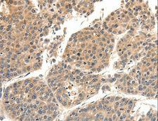 SLC27A1 / FATP Antibody - Immunohistochemistry of paraffin-embedded Human lung cancer using SLC27A1 Polyclonal Antibody at dilution of 1:40.