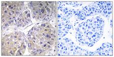 SLC27A5 / BACS Antibody - Immunohistochemistry analysis of paraffin-embedded human liver carcinoma tissue, using SLC27A5 Antibody. The picture on the right is blocked with the synthesized peptide.