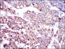 SLC27A5 / BACS Antibody - IHC of paraffin-embedded liver cancer tissues using SLC27A5 mouse monoclonal antibody with DAB staining.