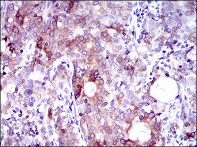 SLC27A5 / BACS Antibody - IHC of paraffin-embedded cervical cancer tissues using SLC27A5 mouse monoclonal antibody with DAB staining.